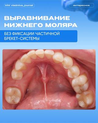 Мини-винт и кнопка для коррекции наклона моляра.